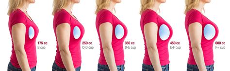 breast expansion meaning|What you need to know about breast augmentation